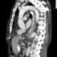 Carcinoma of esophagus, distal esophagus, placement of stent, liver metastasis: CT - Computed tomography